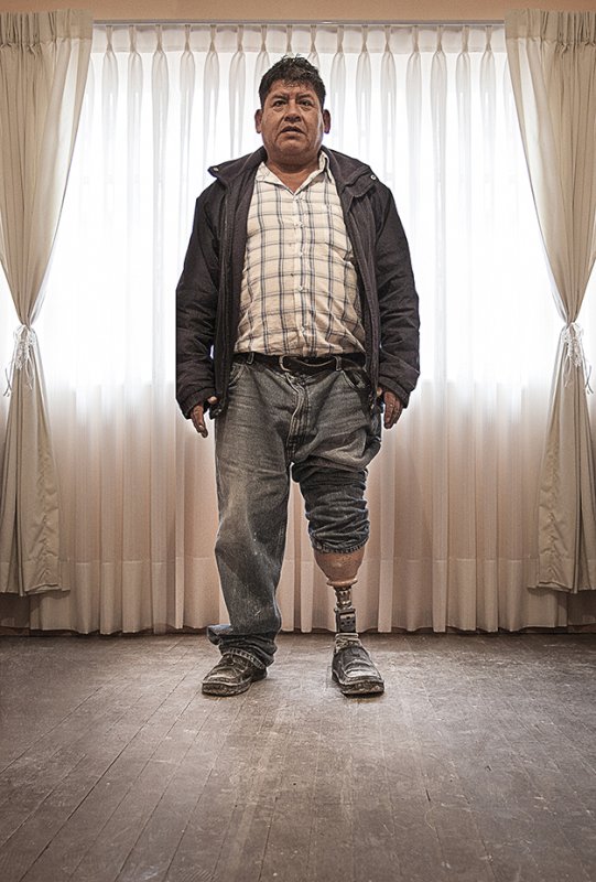 Amputee with prosthetic leg